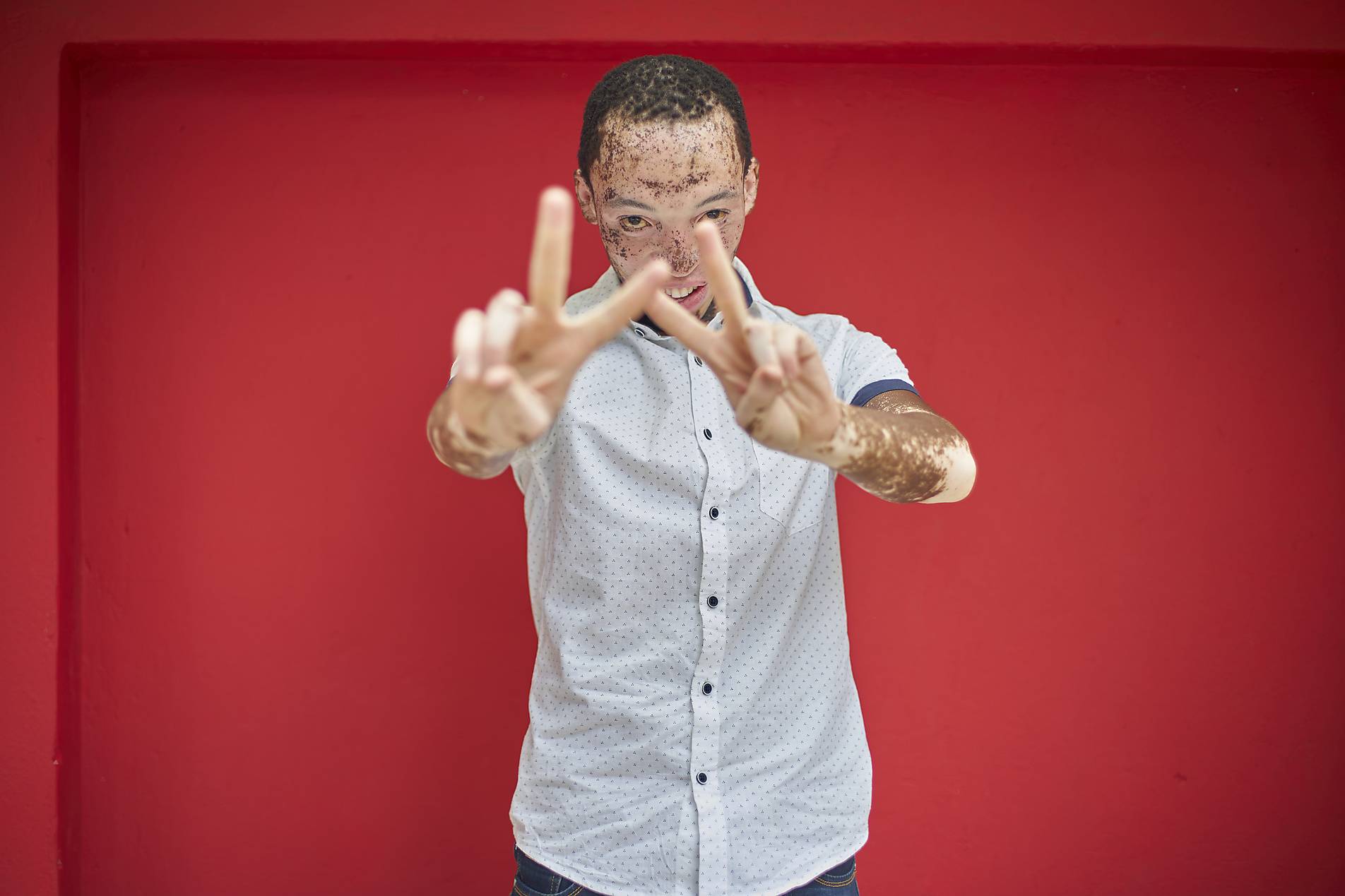 Stock photo, royalty-free, Young man with vitiligo doing the victory sign in front of a red wall