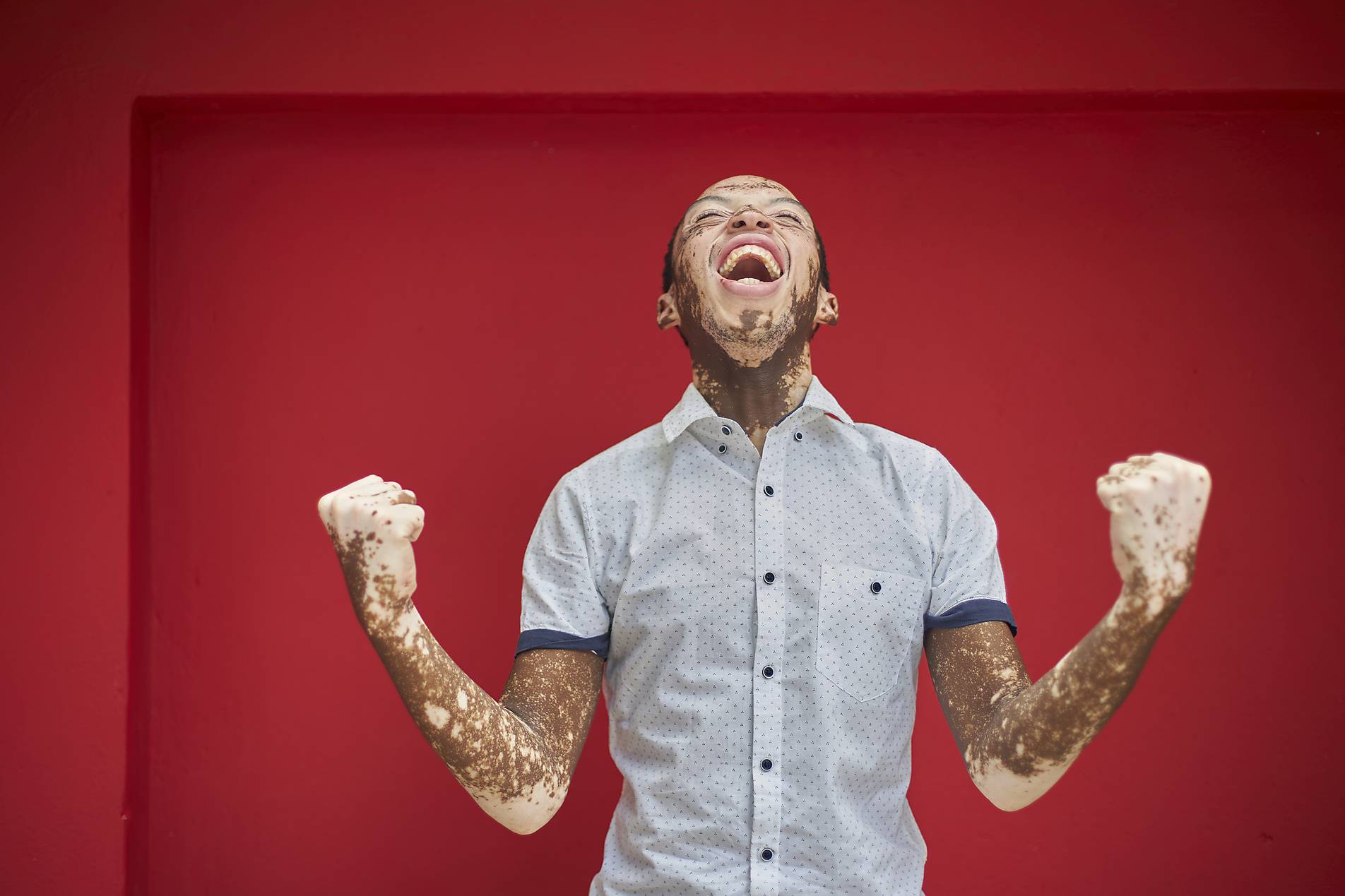 Stock photo, royalty-free, Young man with vitiligo screaming with joy and laughing on a red wall