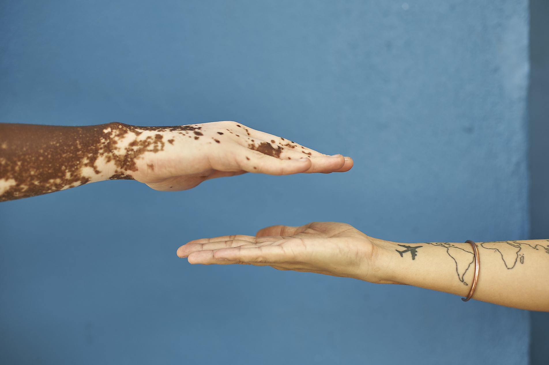 Stock photo, royalty-free, Hand of a man with Vitiligo and a white woman hand against blue wall, Diversity