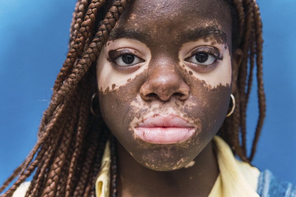 Young woman with depigmentation on face against blue background Royalty free image Young woman with depigmentation on face against blue background
Royalty free image