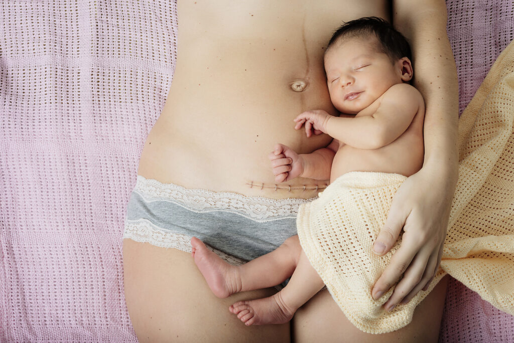 Newborn baby girl lying on mother's thighs near to a recent c-section scar with staples Royalty-free image Newborn baby girl lying on mother's thighs near to a recent c-section scar with staples
Royalty-free image